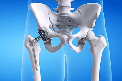 3D illustration of transparent body showing pelvis with titanium hip implant on blue background